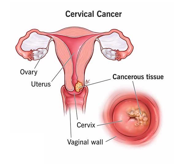 Cancer Screening in Lokhandwala Andheri