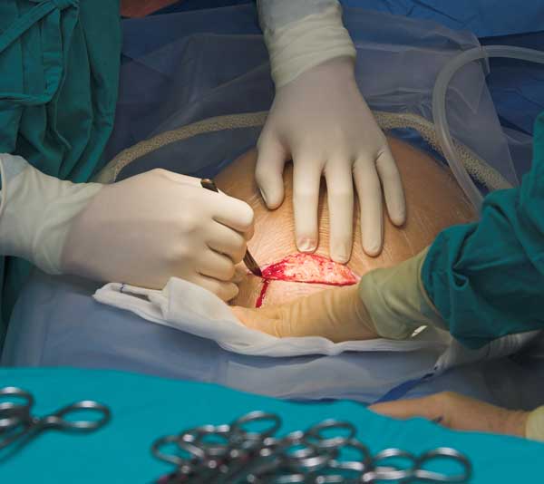 Cesarean Delivery Doctor in Lokhandwala Andheri